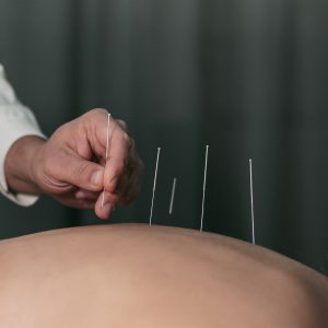 Terapi Nyeri dengan Akupunktur